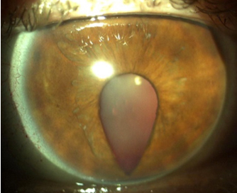 Lensectomía refractiva en coloboma de iris