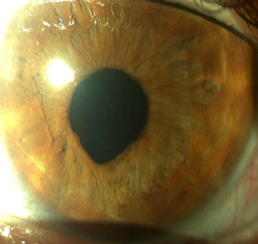 Lensectomía refractiva en coloboma de iris